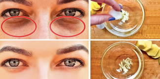 How to Get Rid of Black Circles Under Your Eyes