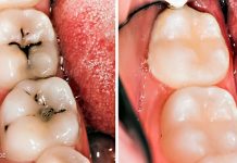 5 easy steps to heal cavities and fight tooth decay