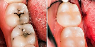 5 easy steps to heal cavities and fight tooth decay