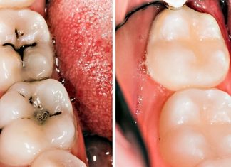 5 easy steps to heal cavities and fight tooth decay