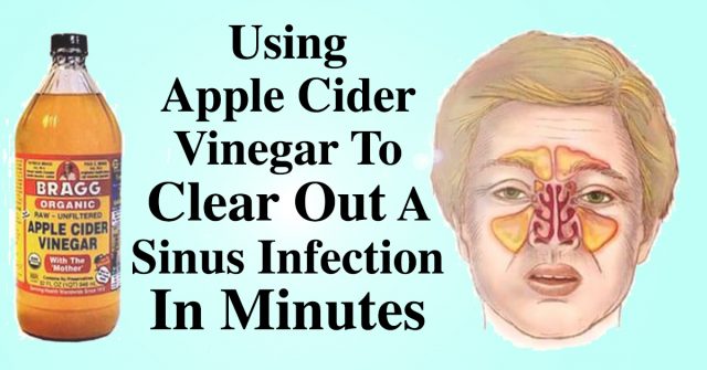 Apple cider vinegar for sinus congestion