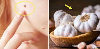 Get Rid Of Moles, Warts, And Skin Tags With These Natural Solutions