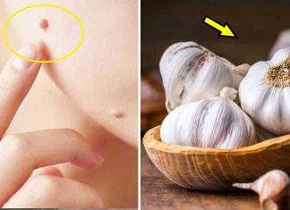 Get Rid Of Moles, Warts, And Skin Tags With These Natural Solutions