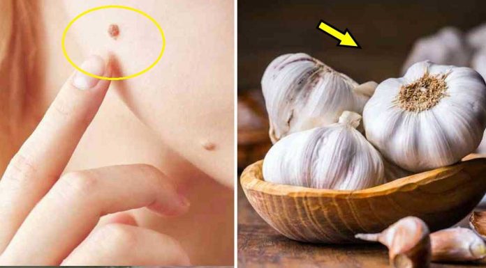 Get Rid Of Moles, Warts, And Skin Tags With These Natural Solutions