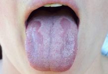 8 Symptoms Of B12 Vitamin Deficiency