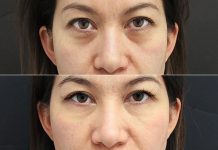 How To Get Rid Of Under-eye Bags In Only 1 Day!