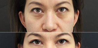 How To Get Rid Of Under-eye Bags In Only 1 Day!