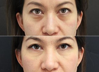 How To Get Rid Of Under-eye Bags In Only 1 Day!