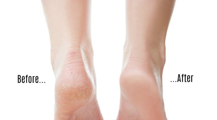 How To Easily Get Rid Of The Dry Skin At The Bottom Of Your Feet