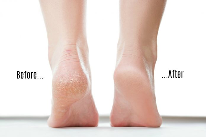 How To Easily Get Rid Of The Dry Skin At The Bottom Of Your Feet - Beauty 2024 | PopcornTime