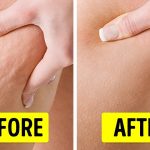 Want To Get Rid Of Cellulite? These Tips Will Help!