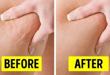 Want To Get Rid Of Cellulite? These Tips Will Help!