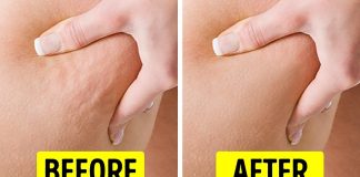 Want To Get Rid Of Cellulite? These Tips Will Help!