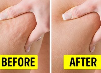 Want To Get Rid Of Cellulite? These Tips Will Help!