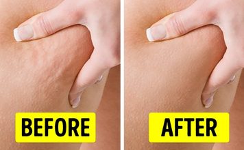 Want To Get Rid Of Cellulite? These Tips Will Help!