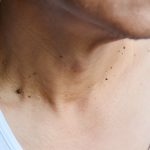 Skin Cancer: Everyone Forgets To Check These 10 Spots!