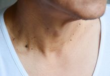 Skin Cancer: Everyone Forgets To Check These 10 Spots!