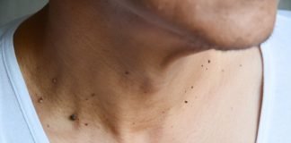 Skin Cancer: Everyone Forgets To Check These 10 Spots!