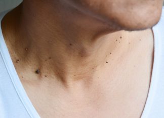 Skin Cancer: Everyone Forgets To Check These 10 Spots!