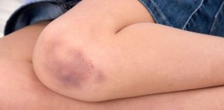 Do You Bruise So Easily? Here Are 5 Reasons Why.