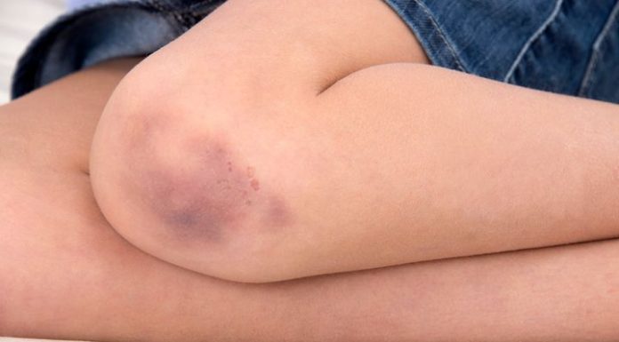 Do You Bruise So Easily? Here Are 5 Reasons Why.