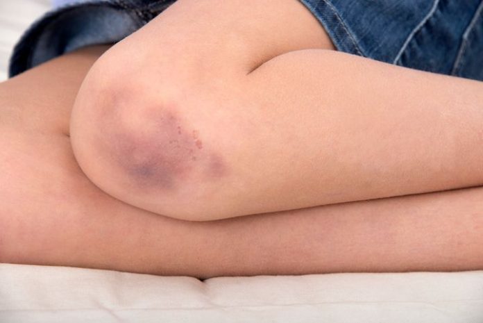 Do You Bruise So Easily? Here Are 5 Reasons Why. - Health 2024 | PopcornTime