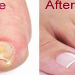 How To Get Rid Of Toenail Fungus Naturally & Fast!