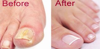 How To Get Rid Of Toenail Fungus Naturally & Fast!
