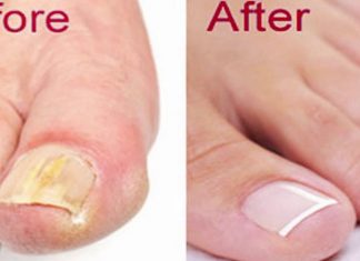 How To Get Rid Of Toenail Fungus Naturally & Fast!