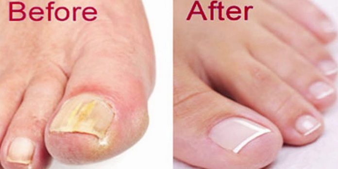 How To Get Rid Of Toenail Fungus Naturally & Fast! - Health 2024 | PopcornTime