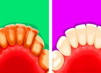 Natural Ways To Fight Tartar Build-Up At Home.
