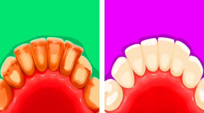 Natural Ways To Fight Tartar Build-Up At Home.