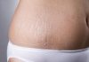 How To Remove Stretch Marks And Hide Them For Good