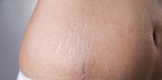 How To Remove Stretch Marks And Hide Them For Good