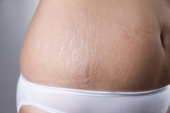 How To Remove Stretch Marks And Hide Them For Good - Beauty 2024 | PopcornTime