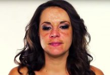 Pigment Moustache: How To Get Rid Of Discolorations On Your Face.