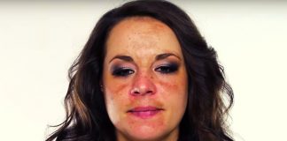 Pigment Moustache: How To Get Rid Of Discolorations On Your Face.