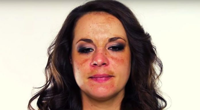Pigment Moustache: How To Get Rid Of Discolorations On Your Face.