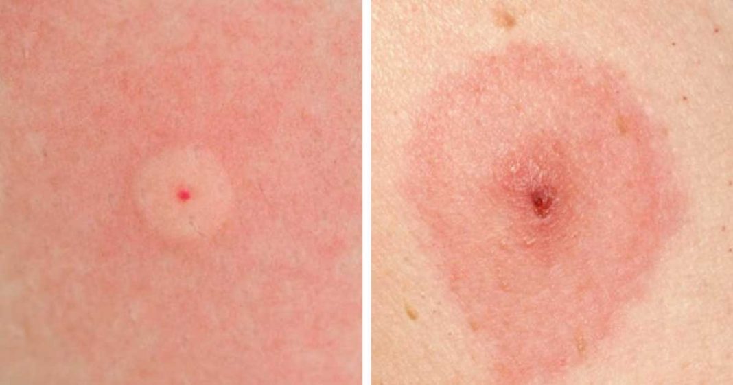 how-to-identify-10-of-the-most-common-bug-bites-grandma-s-things