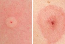 How To Identify 10 Of The Most Common Bug Bites