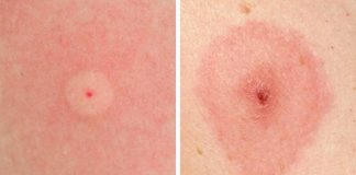 How To Identify 10 Of The Most Common Bug Bites