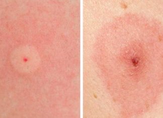 How To Identify 10 Of The Most Common Bug Bites