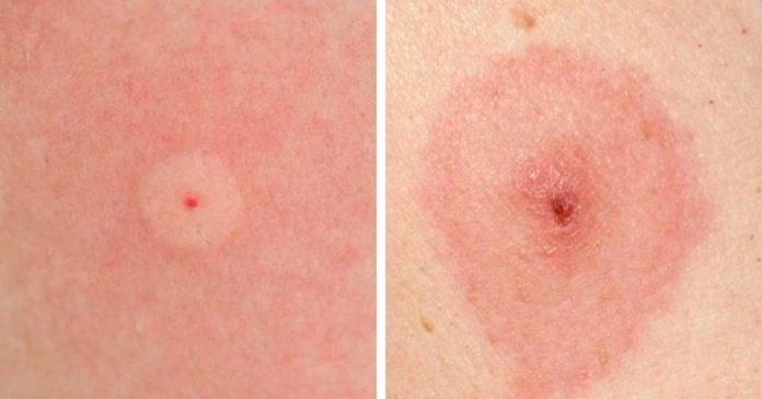 how-to-identify-10-of-the-most-common-bug-bites-grandma-s-things