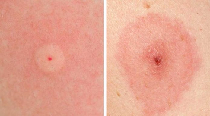 How To Identify 10 Of The Most Common Bug Bites