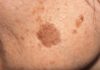Simple Trick to Remove Brown Spots from Your Skin