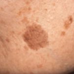 Simple Trick to Remove Brown Spots from Your Skin