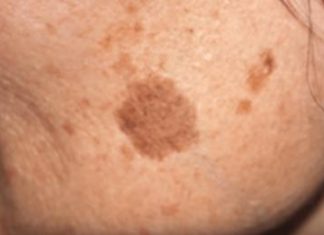 Simple Trick to Remove Brown Spots from Your Skin