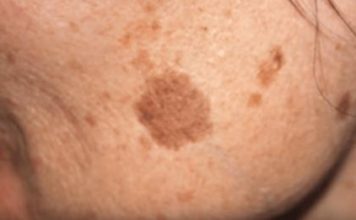 Simple Trick to Remove Brown Spots from Your Skin