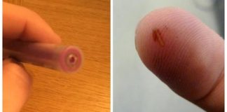 Mom Shares Genius Trick For Removing Splinters