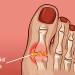 9 potent ways to reduce uric acid naturally